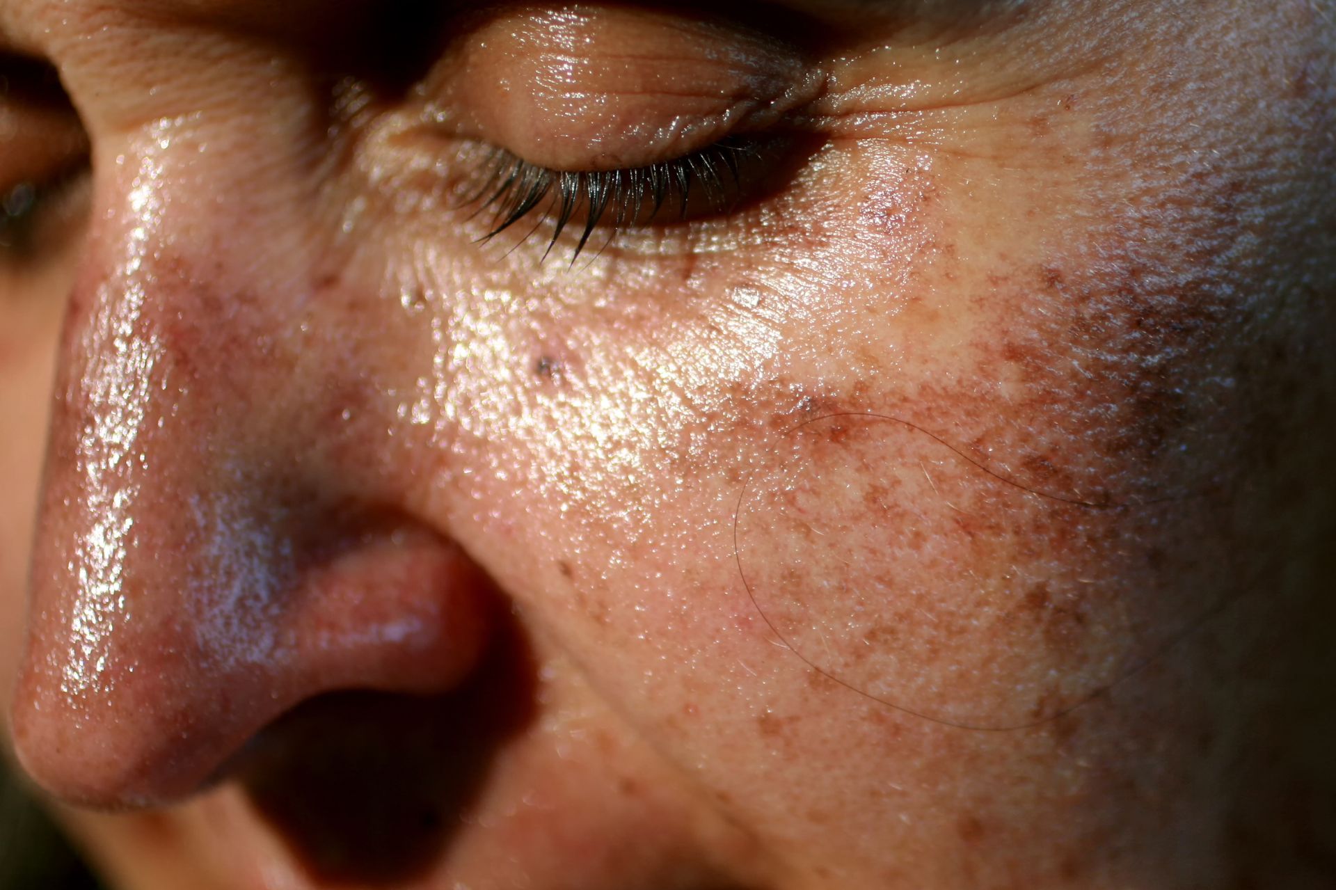 la ménopause affecte les taches solaires de la peau