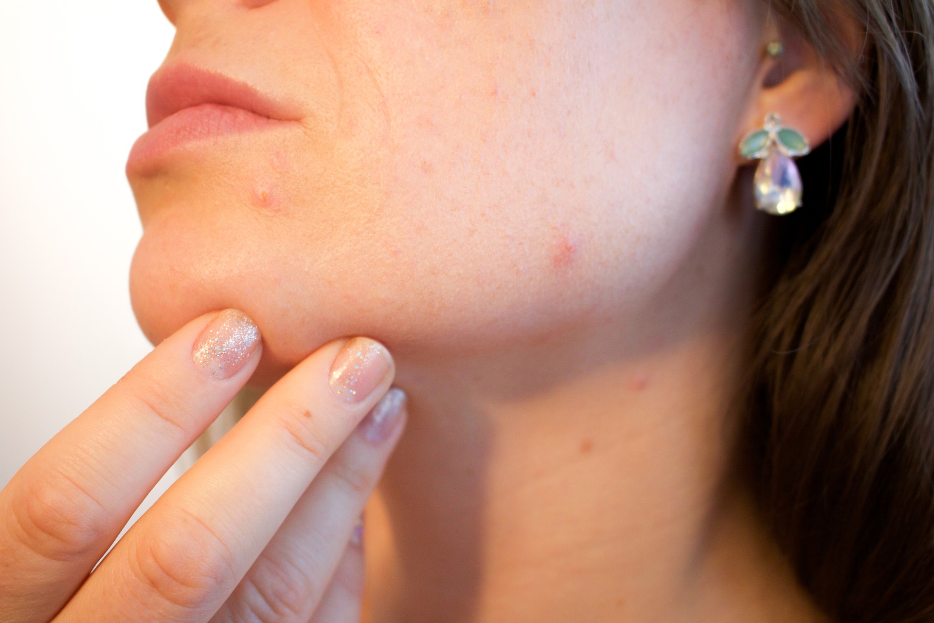 la ménopause affecte la peau, l'acné hormonale